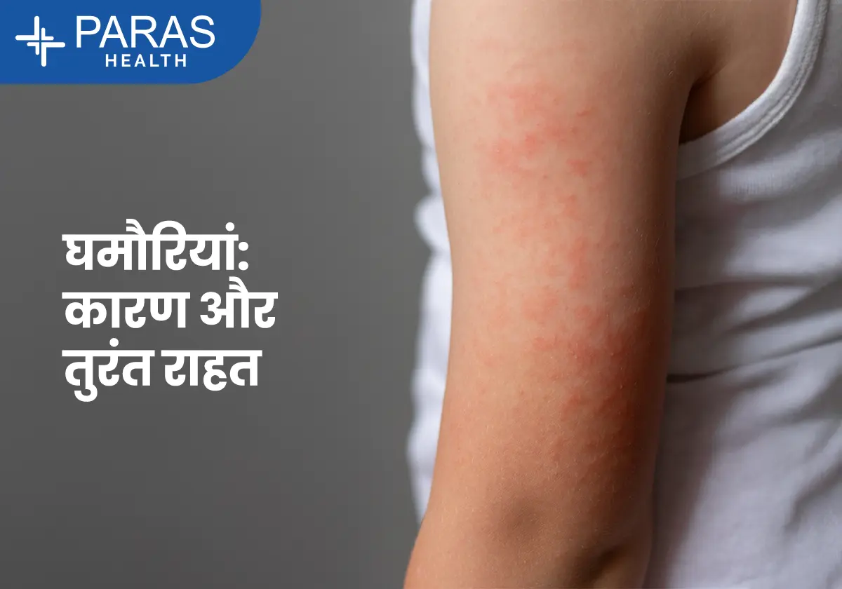 घमौरियां: कारण, लक्षण, घरेलू उपाय और बचाव के आसान तरीके